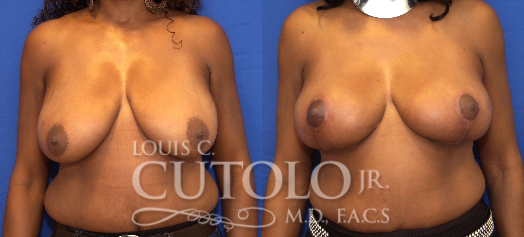 Before & After Breast Lift Case 58 View #1 View in Brooklyn, Staten Island, Queens, NY