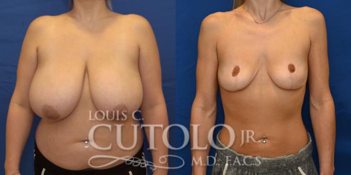 Anterior before