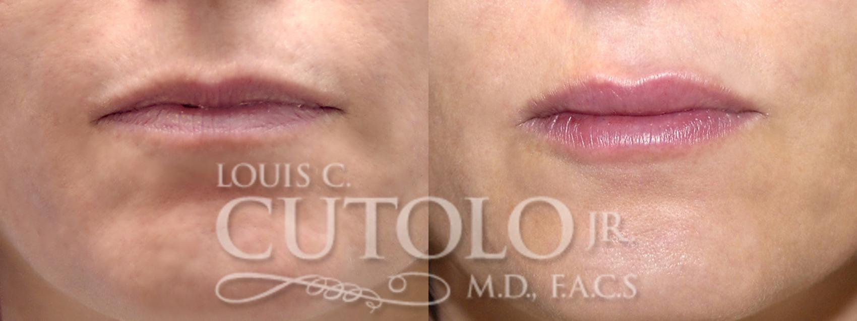 Before & After Dermal Fillers Case 11 View #1 View in Brooklyn, Staten Island, Queens, NY