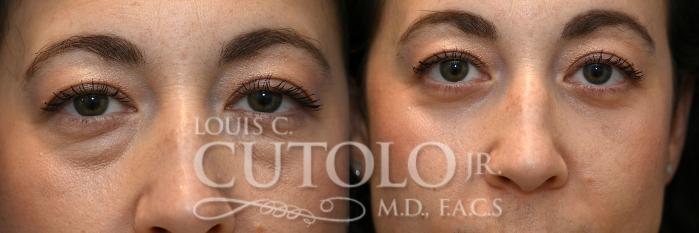 Anterior before