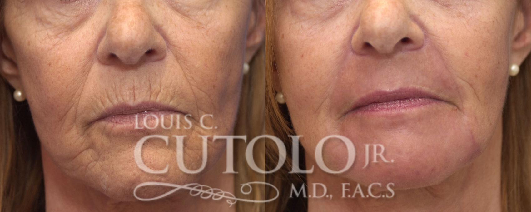 Before & After Laser Skin Resurfacing Case 150 View #1 View in Brooklyn, Staten Island, Queens, NY