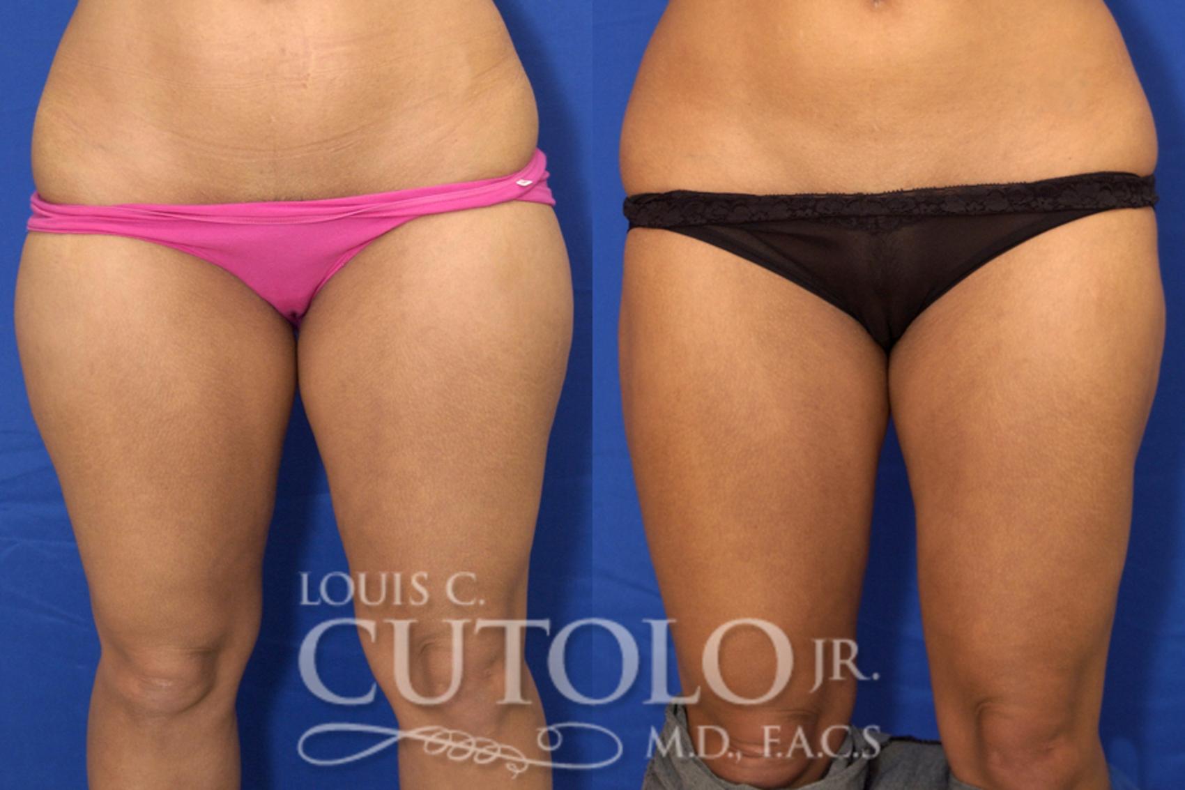 Before & After Liposuction Case 12 View #1 View in Brooklyn, Staten Island, Queens, NY