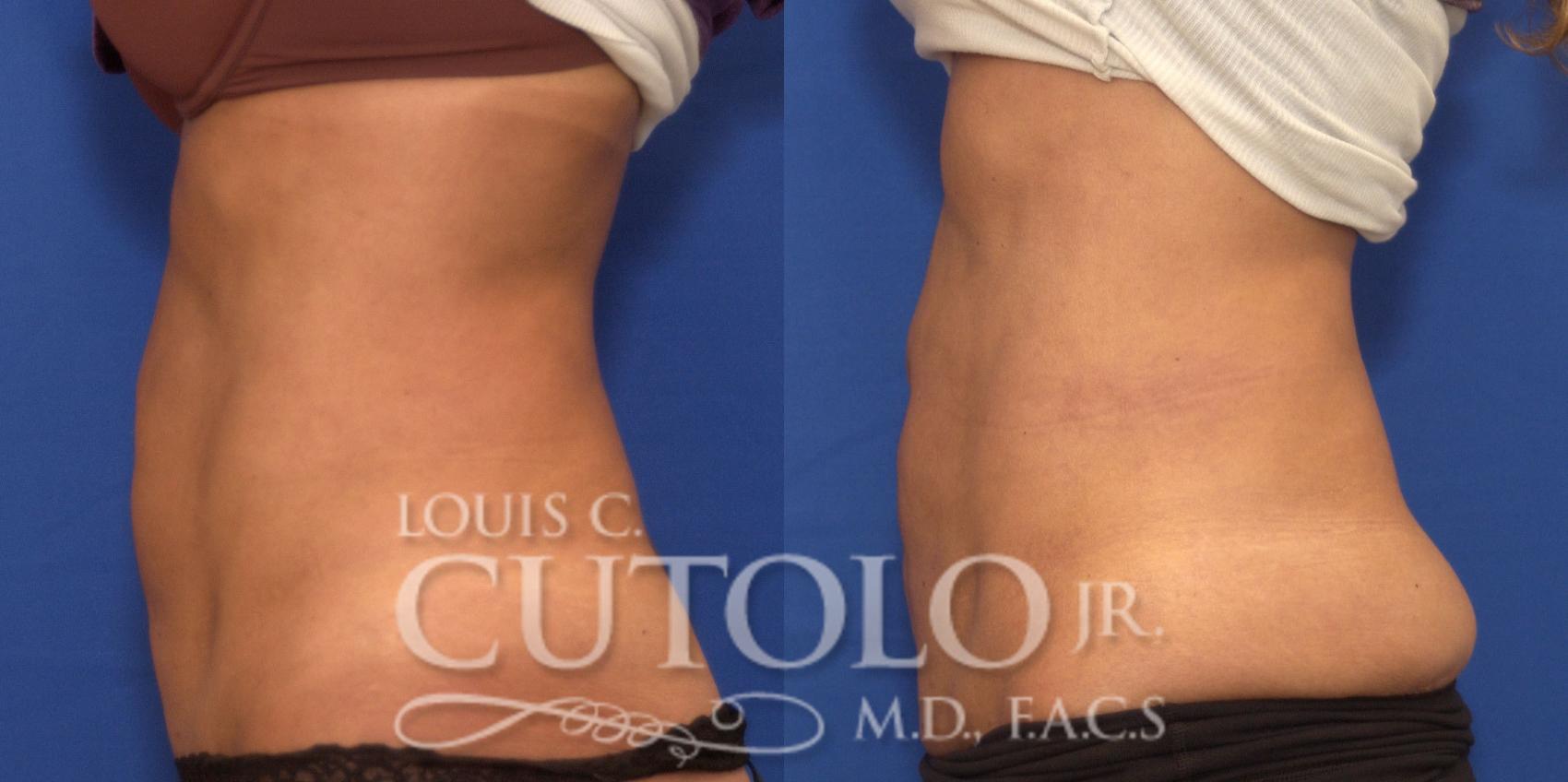 Before & After BodyTite Case 206 View #3 View in Brooklyn, Staten Island, Queens, NY