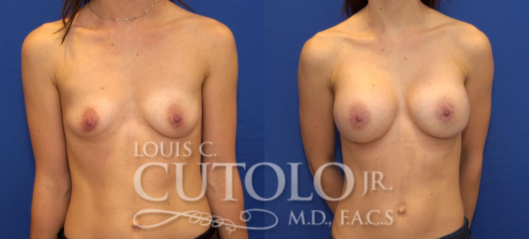 Before & After Breast Augmentation Case 100 View #1 View in Brooklyn, Staten Island, Queens, NY