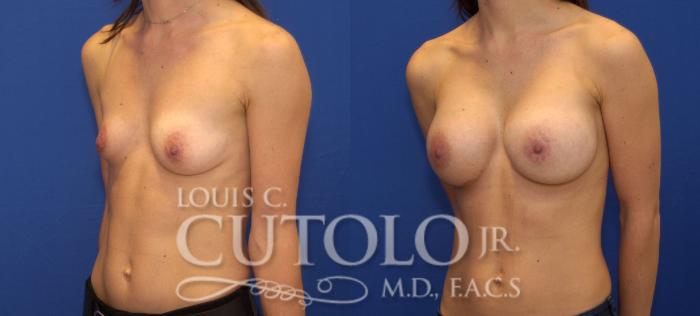 Before & After Breast Augmentation Case 100 View #2 View in Brooklyn, Staten Island, Queens, NY