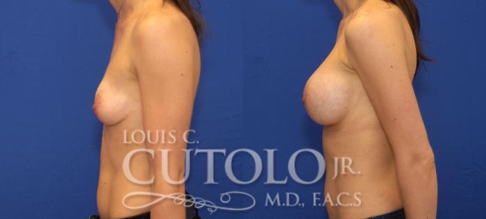 Before & After Breast Augmentation Case 100 View #3 View in Brooklyn, Staten Island, Queens, NY