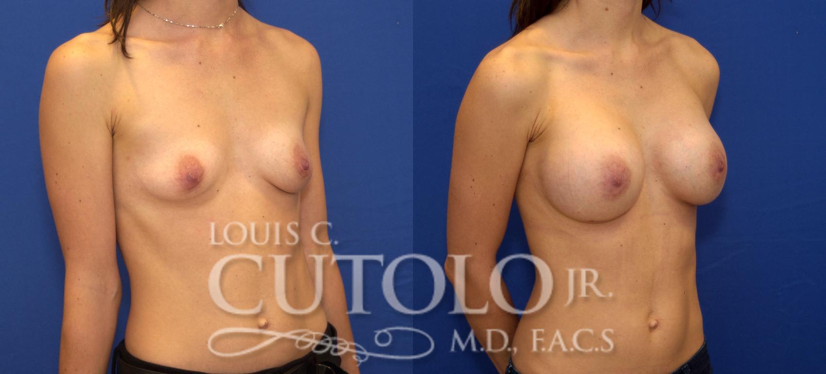 Before & After Breast Augmentation Case 100 View #4 View in Brooklyn, Staten Island, Queens, NY