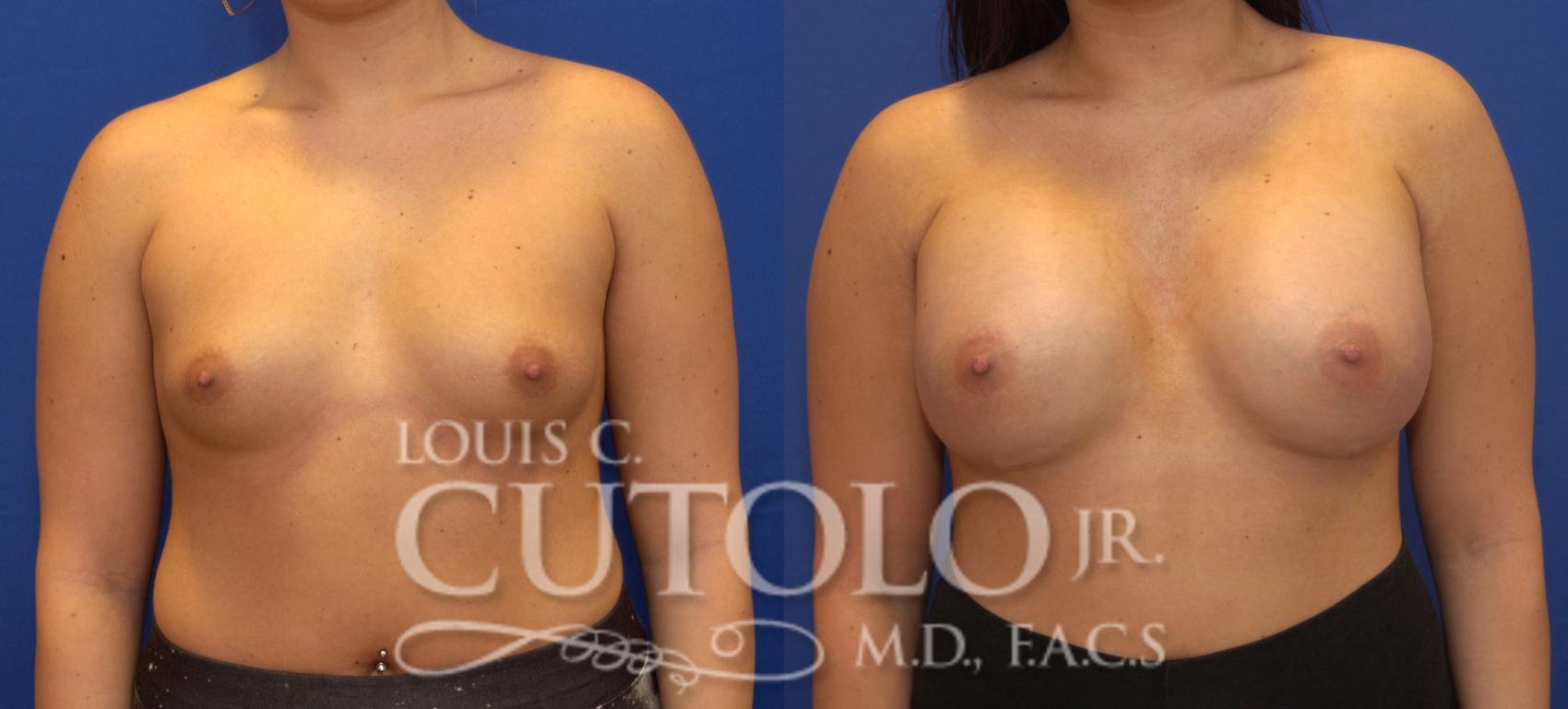 Before & After Breast Augmentation Case 101 View #1 View in Brooklyn, Staten Island, Queens, NY