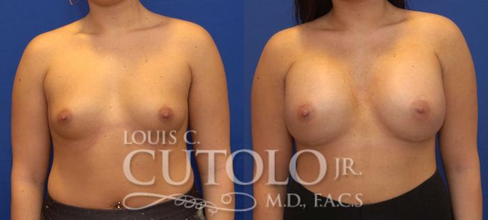 Before & After Breast Augmentation Case 101 View #1 View in Brooklyn, Staten Island, Queens, NY