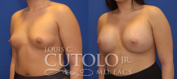 Before & After Breast Augmentation Case 101 View #2 View in Brooklyn, Staten Island, Queens, NY