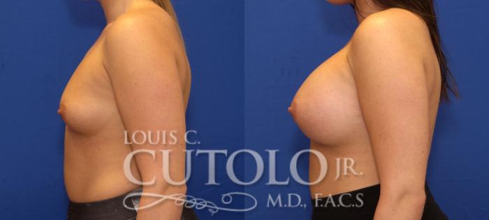 Before & After Breast Augmentation Case 101 View #3 View in Brooklyn, Staten Island, Queens, NY