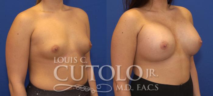 Before & After Breast Augmentation Case 101 View #4 View in Brooklyn, Staten Island, Queens, NY