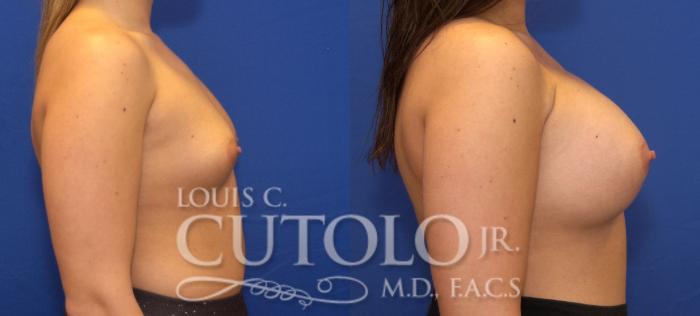 Before & After Breast Augmentation Case 101 View #5 View in Brooklyn, Staten Island, Queens, NY