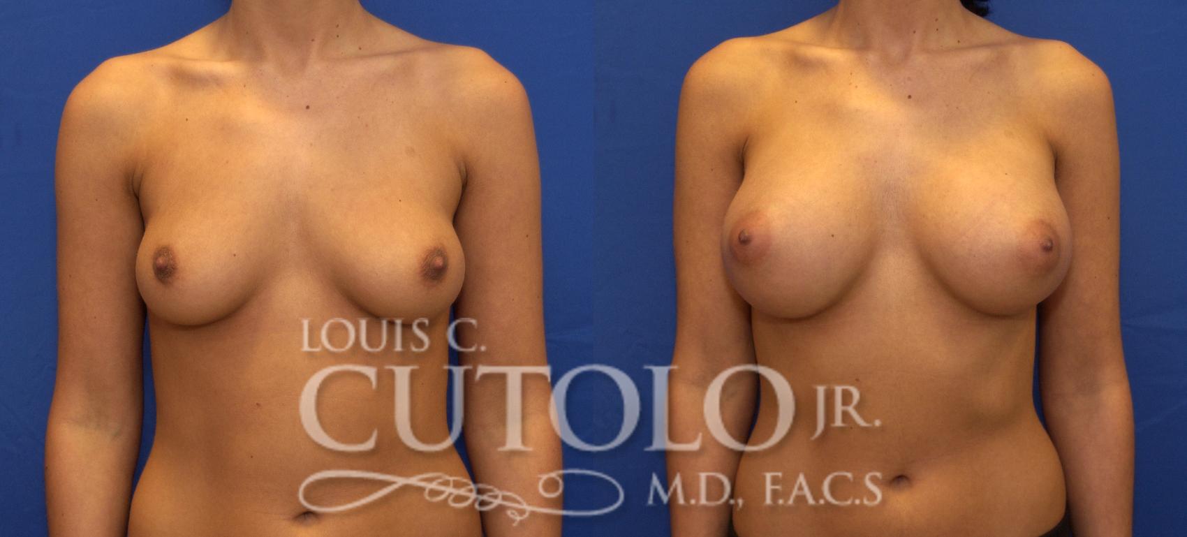 Before & After Breast Augmentation Case 102 View #1 View in Brooklyn, Staten Island, Queens, NY