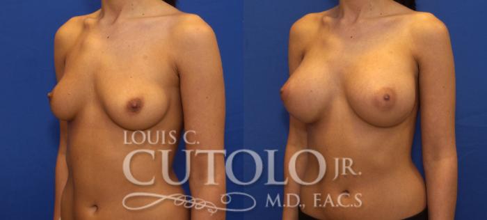 Before & After Breast Augmentation Case 102 View #2 View in Brooklyn, Staten Island, Queens, NY