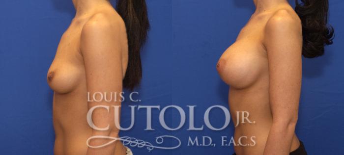 Before & After Breast Augmentation Case 102 View #3 View in Brooklyn, Staten Island, Queens, NY