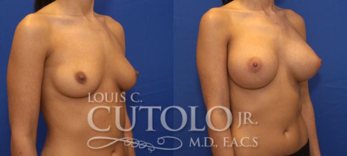 Before & After Breast Augmentation Case 102 View #4 View in Brooklyn, Staten Island, Queens, NY