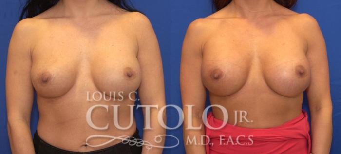 Before & After Breast Augmentation Case 106 View #1 View in Brooklyn, Staten Island, Queens, NY