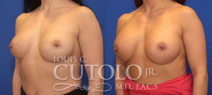 Before & After Breast Augmentation Case 106 View #2 View in Brooklyn, Staten Island, Queens, NY