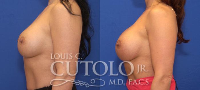 Before & After Breast Augmentation Case 106 View #3 View in Brooklyn, Staten Island, Queens, NY