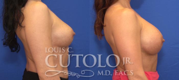 Before & After Breast Augmentation Case 106 View #5 View in Brooklyn, Staten Island, Queens, NY