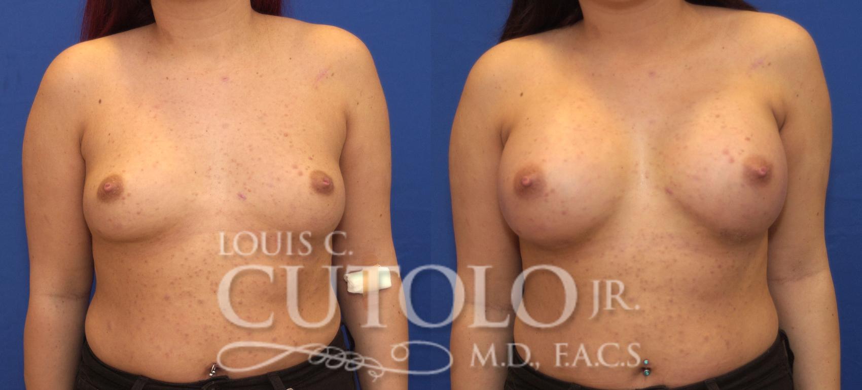 Before & After Breast Augmentation Case 107 View #1 View in Brooklyn, Staten Island, Queens, NY