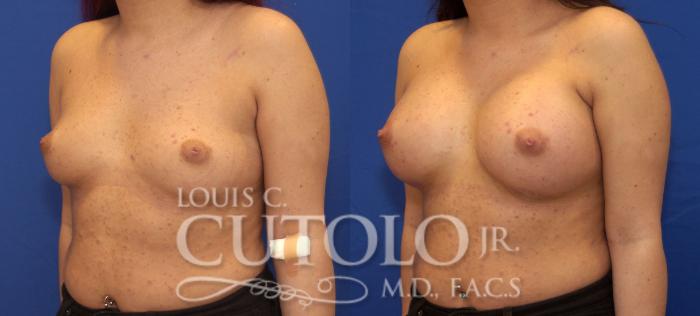 Before & After Breast Augmentation Case 107 View #2 View in Brooklyn, Staten Island, Queens, NY