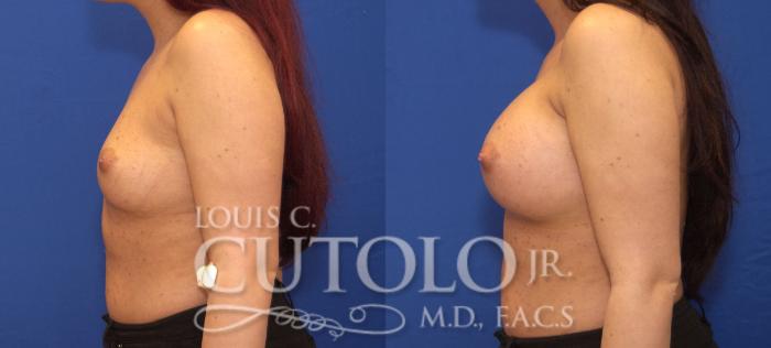 Before & After Breast Augmentation Case 107 View #3 View in Brooklyn, Staten Island, Queens, NY