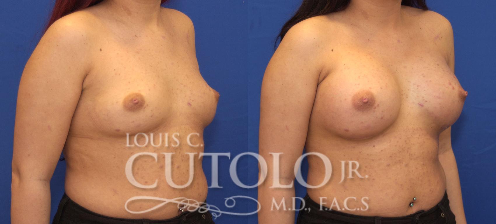 Before & After Breast Augmentation Case 107 View #4 View in Brooklyn, Staten Island, Queens, NY