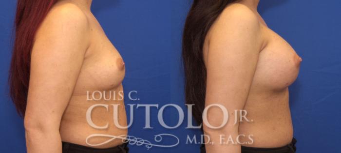 Before & After Breast Augmentation Case 107 View #5 View in Brooklyn, Staten Island, Queens, NY