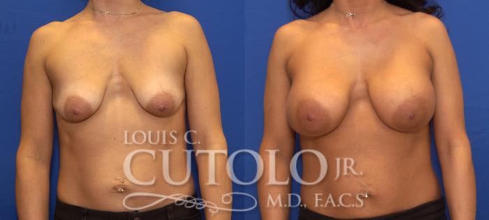 Before & After Breast Augmentation Case 108 View #1 View in Brooklyn, Staten Island, Queens, NY
