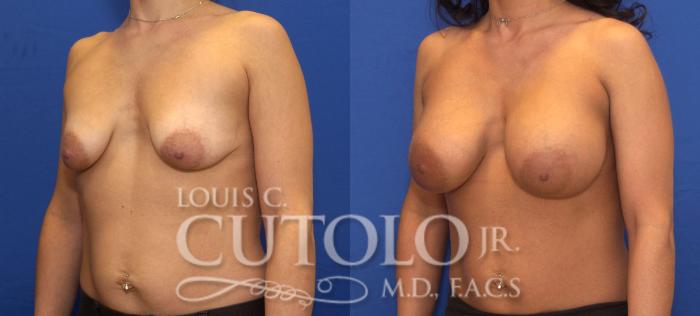 Before & After Breast Augmentation Case 108 View #2 View in Brooklyn, Staten Island, Queens, NY