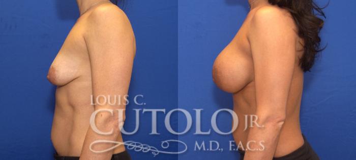 Before & After Breast Augmentation Case 108 View #3 View in Brooklyn, Staten Island, Queens, NY