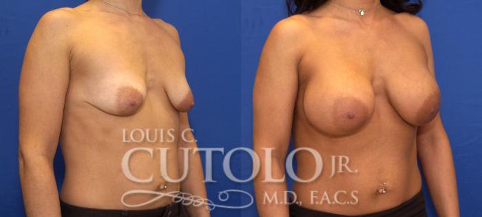 Before & After Breast Augmentation Case 108 View #4 View in Brooklyn, Staten Island, Queens, NY