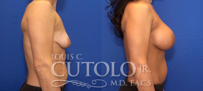 Before & After Breast Augmentation Case 108 View #5 View in Brooklyn, Staten Island, Queens, NY