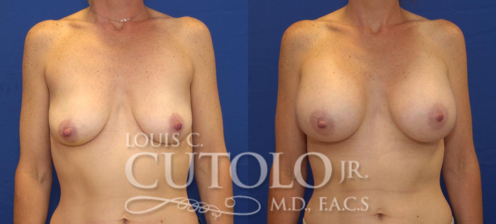 Before & After Breast Augmentation Case 113 View #1 View in Brooklyn, Staten Island, Queens, NY