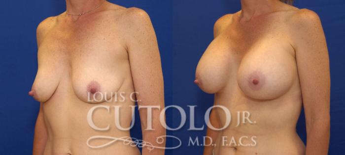 Before & After Breast Augmentation Case 113 View #2 View in Brooklyn, Staten Island, Queens, NY