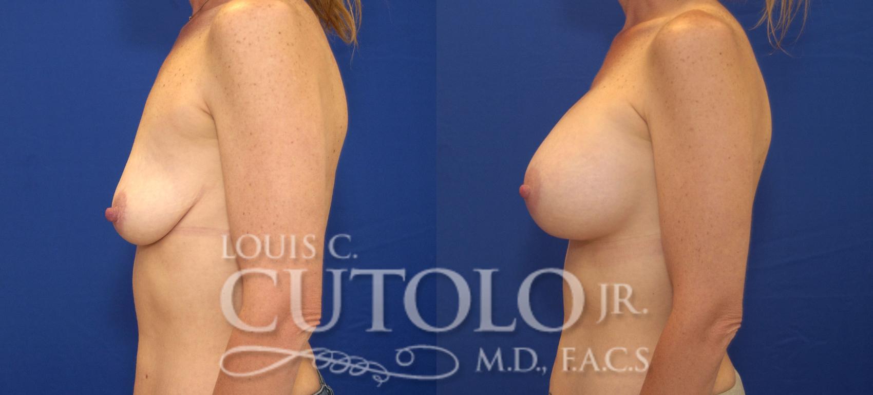 Before & After Breast Augmentation Case 113 View #3 View in Brooklyn, Staten Island, Queens, NY