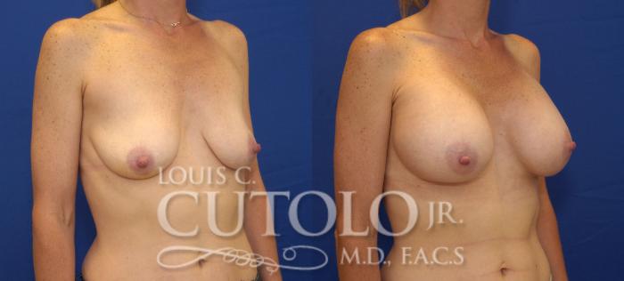 Before & After Breast Augmentation Case 113 View #4 View in Brooklyn, Staten Island, Queens, NY