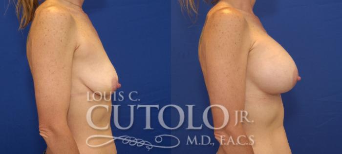 Before & After Breast Augmentation Case 113 View #5 View in Brooklyn, Staten Island, Queens, NY