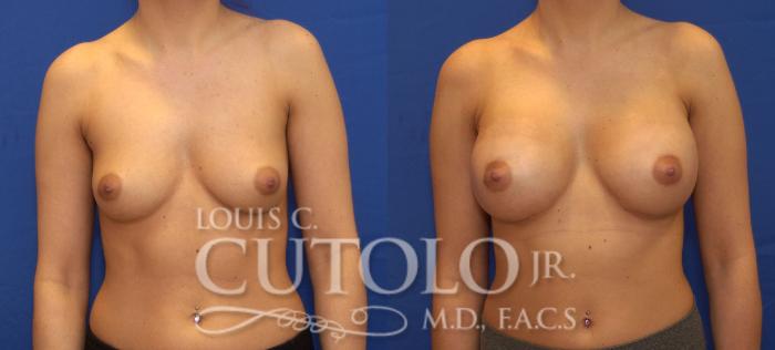 Before & After Breast Augmentation Case 114 View #1 View in Brooklyn, Staten Island, Queens, NY