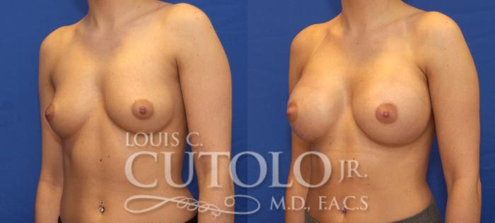 Before & After Breast Augmentation Case 114 View #2 View in Brooklyn, Staten Island, Queens, NY