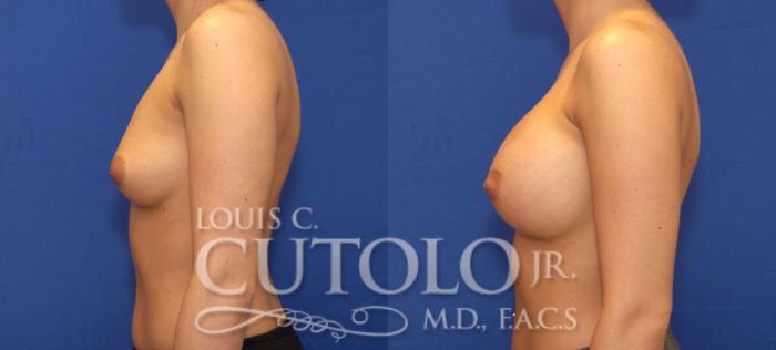 Before & After Breast Augmentation Case 114 View #3 View in Brooklyn, Staten Island, Queens, NY