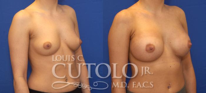 Before & After Breast Augmentation Case 114 View #4 View in Brooklyn, Staten Island, Queens, NY
