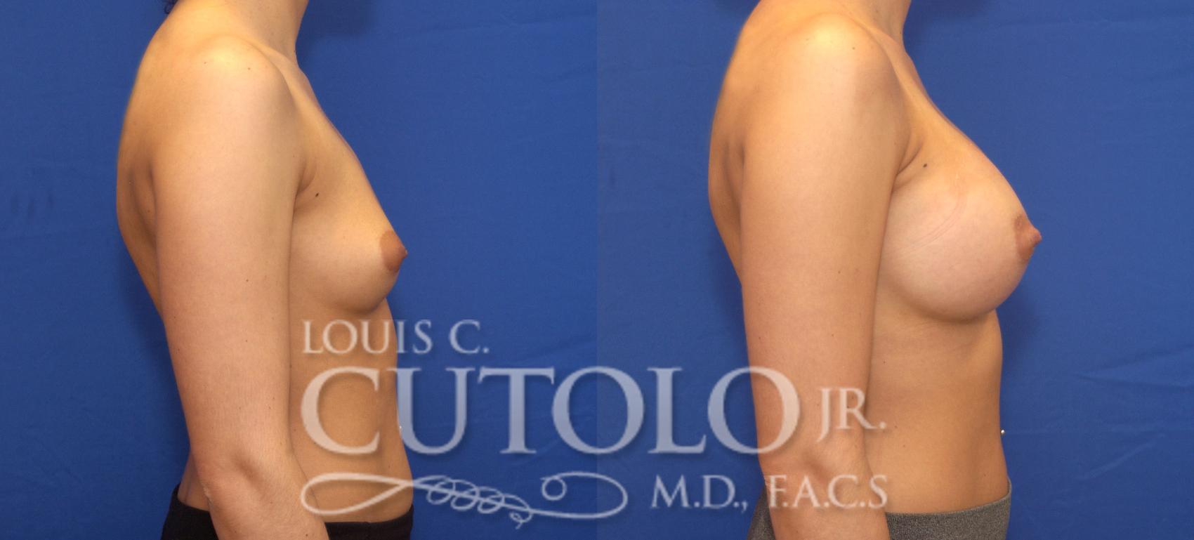 Before & After Breast Augmentation Case 114 View #5 View in Brooklyn, Staten Island, Queens, NY