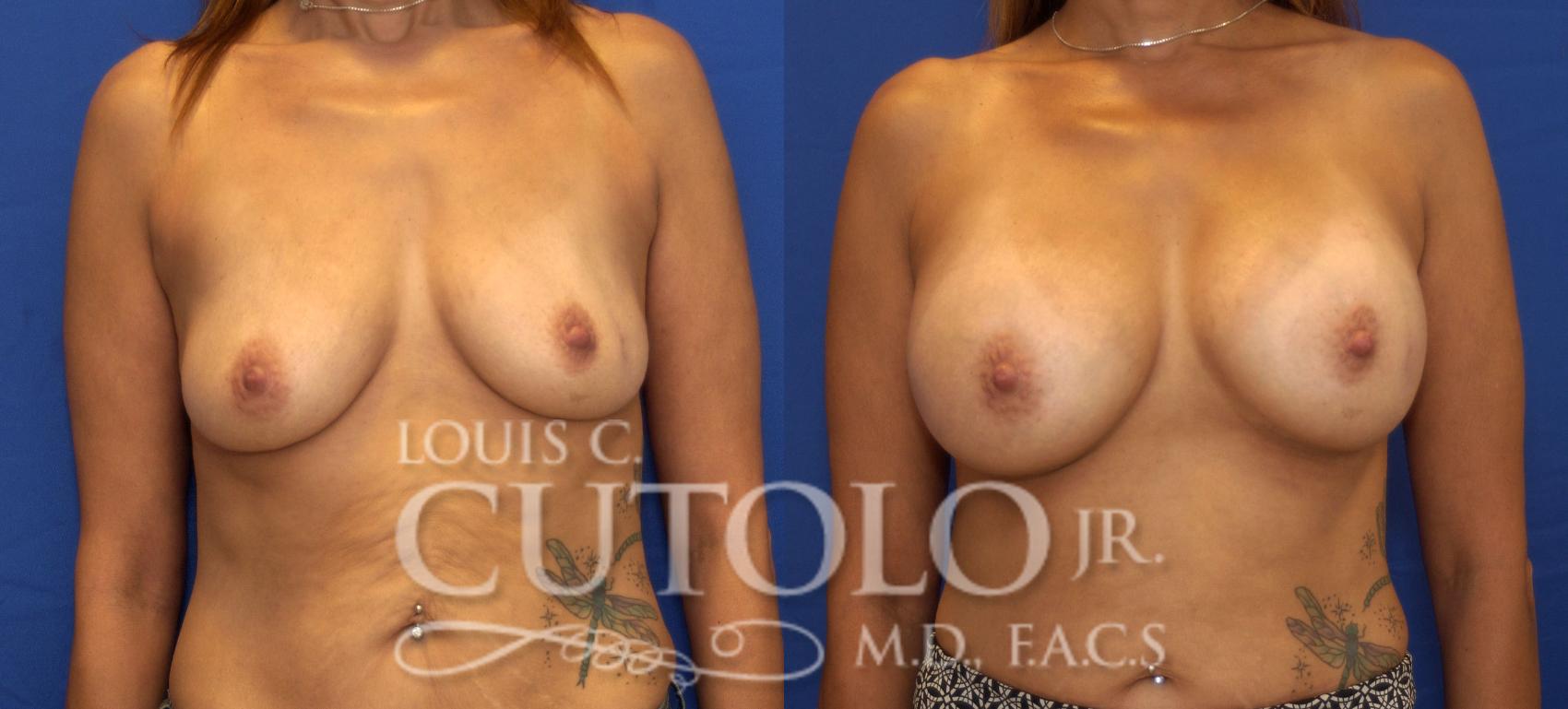 Before & After Breast Augmentation Case 116 View #1 View in Brooklyn, Staten Island, Queens, NY
