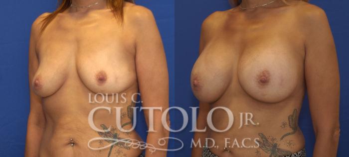 Before & After Breast Augmentation Case 116 View #2 View in Brooklyn, Staten Island, Queens, NY
