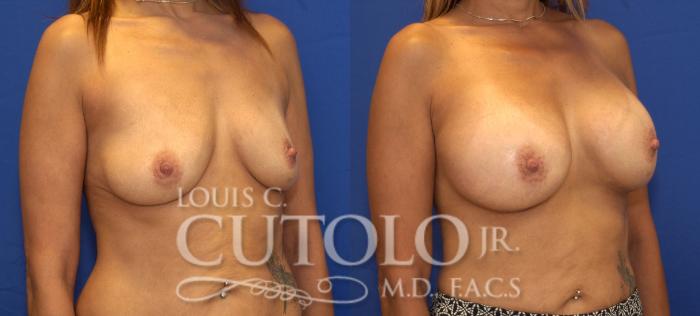 Before & After Breast Augmentation Case 116 View #4 View in Brooklyn, Staten Island, Queens, NY