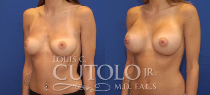 Before & After Breast Augmentation Case 119 View #2 View in Brooklyn, Staten Island, Queens, NY