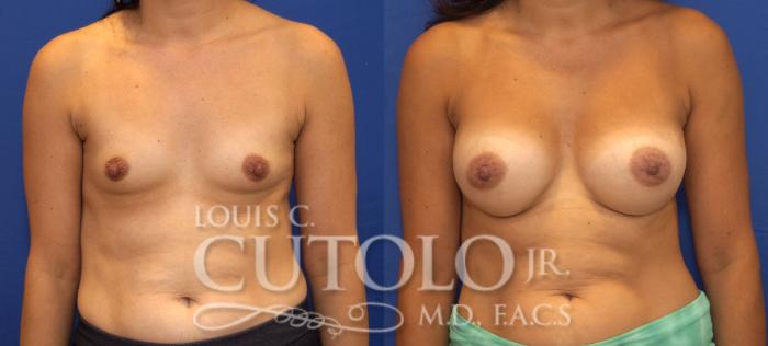 Before & After Breast Augmentation Case 120 View #1 View in Brooklyn, Staten Island, Queens, NY